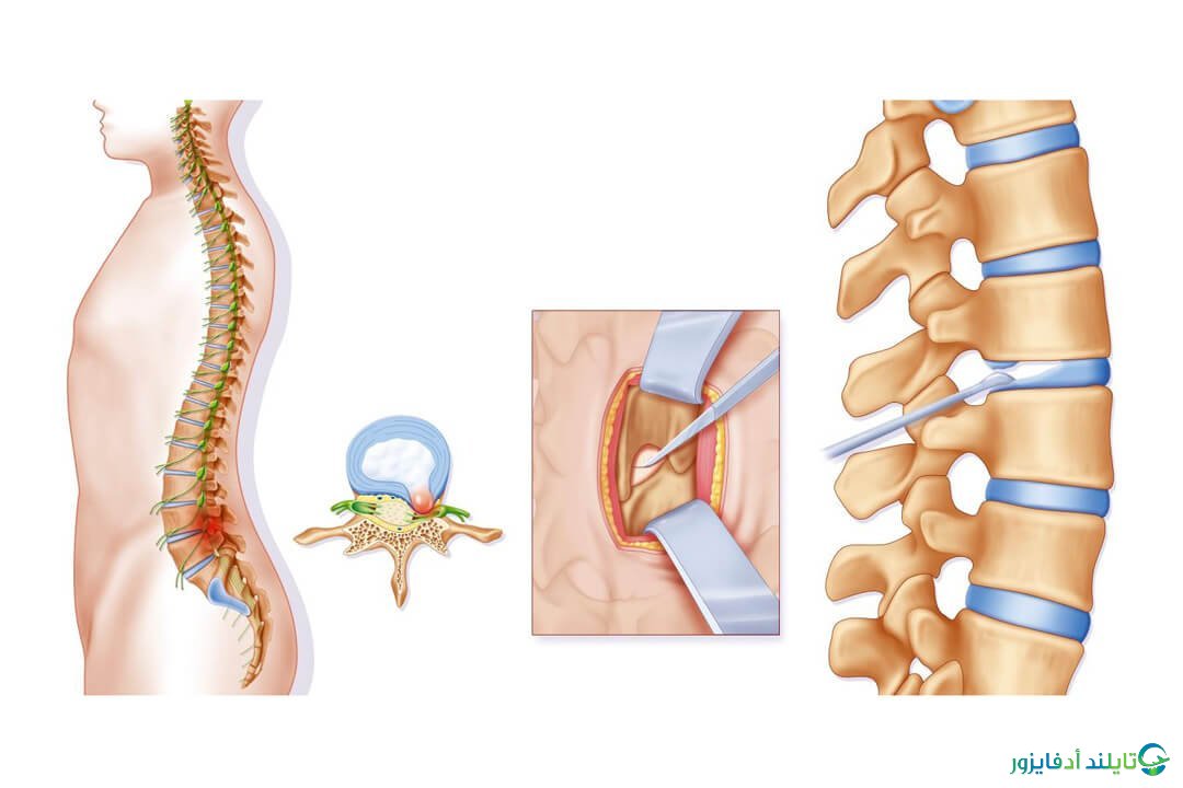 اجراءات وتكاليف عملية الديسك بالليزر وبدون جراحة في تايلاند