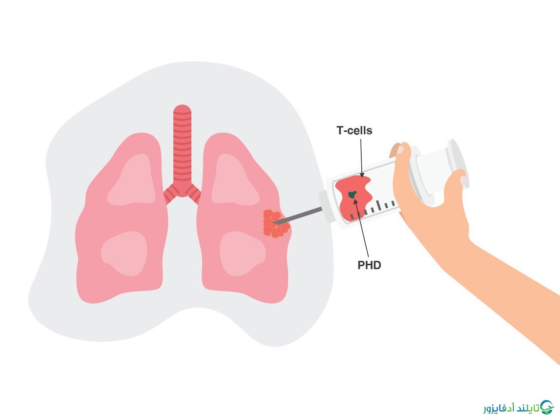 خدمات واجراءات العلاج المناعي لمرضي السرطان في تايلاند